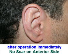 plastic-surgery-prominent-ear 